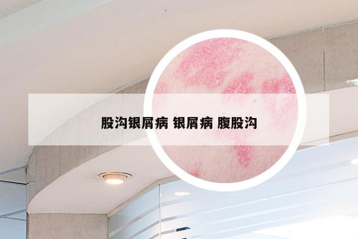 股沟银屑病 银屑病 腹股沟