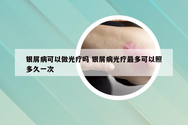 银屑病可以做光疗吗 银屑病光疗最多可以照多久一次