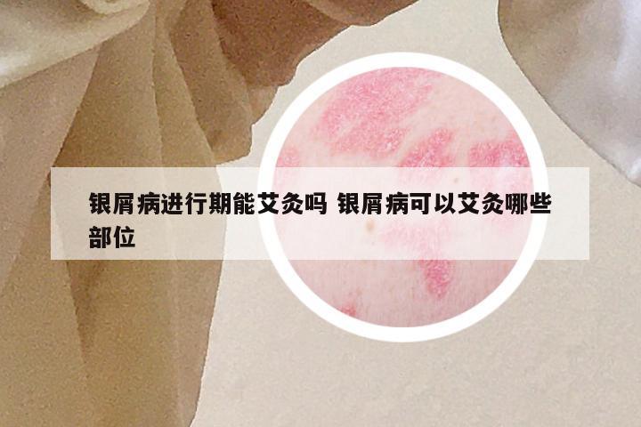 银屑病进行期能艾灸吗 银屑病可以艾灸哪些部位