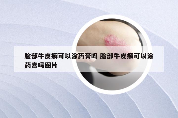 脸部牛皮癣可以涂药膏吗 脸部牛皮癣可以涂药膏吗图片