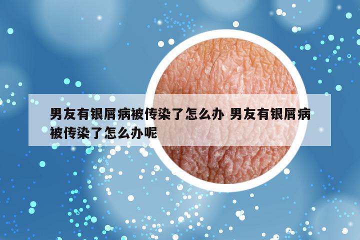 男友有银屑病被传染了怎么办 男友有银屑病被传染了怎么办呢