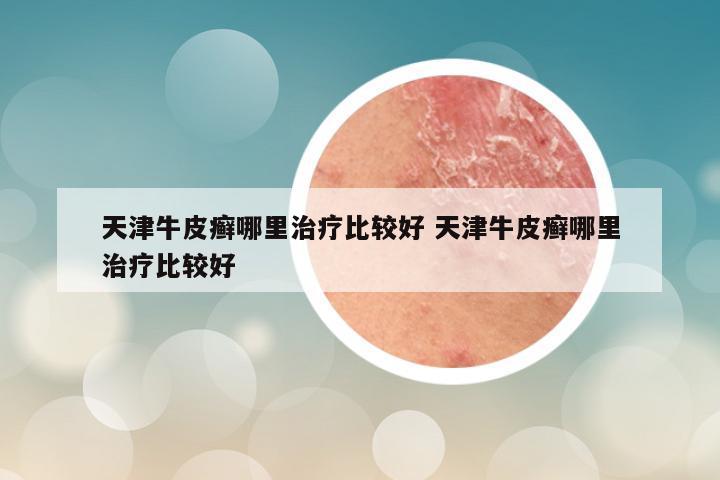 天津牛皮癣哪里治疗比较好 天津牛皮癣哪里治疗比较好
