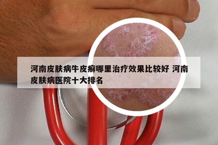 河南皮肤病牛皮癣哪里治疗效果比较好 河南皮肤病医院十大排名