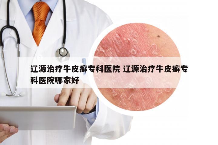 辽源治疗牛皮癣专科医院 辽源治疗牛皮癣专科医院哪家好