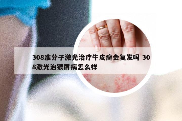 308准分子激光治疗牛皮癣会复发吗 308激光治银屑病怎么样