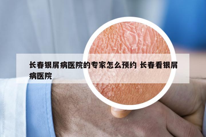 长春银屑病医院的专家怎么预约 长春看银屑病医院