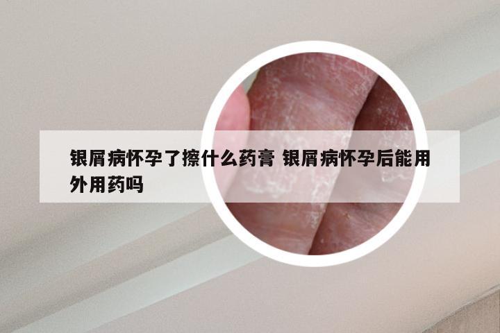 银屑病怀孕了擦什么药膏 银屑病怀孕后能用外用药吗
