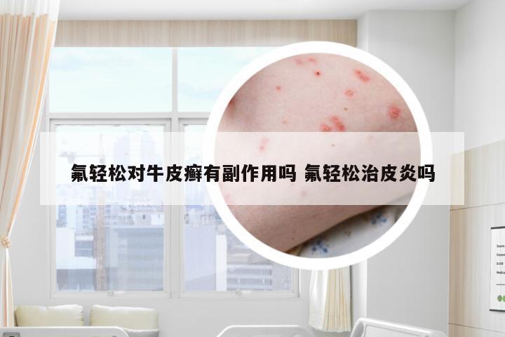 氟轻松对牛皮癣有副作用吗 氟轻松治皮炎吗