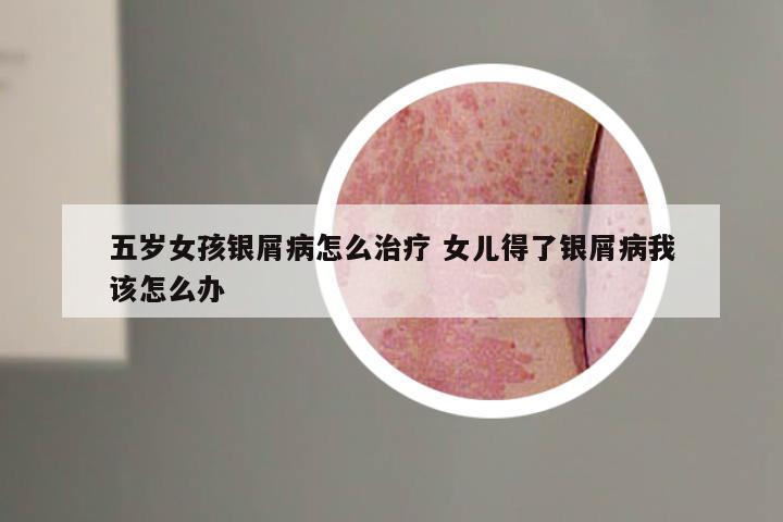 五岁女孩银屑病怎么治疗 女儿得了银屑病我该怎么办