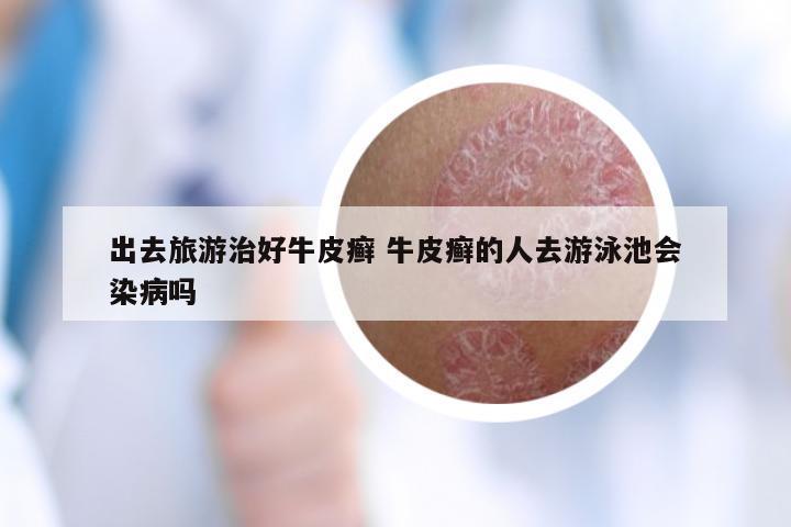 出去旅游治好牛皮癣 牛皮癣的人去游泳池会染病吗