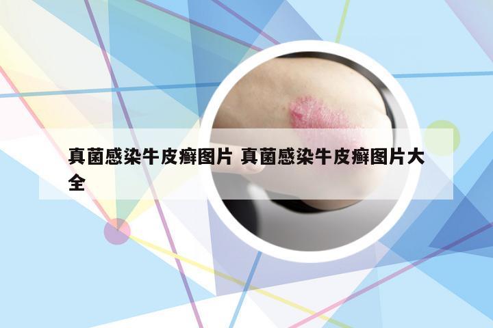 真菌感染牛皮癣图片 真菌感染牛皮癣图片大全