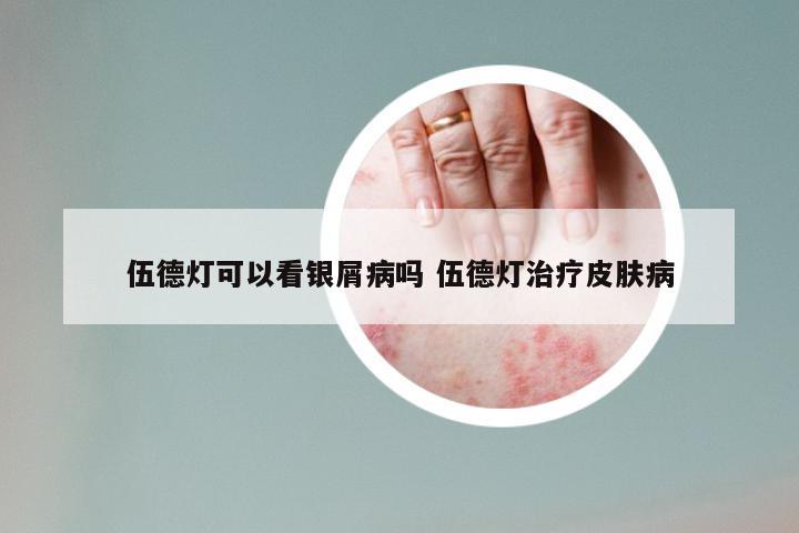 伍德灯可以看银屑病吗 伍德灯治疗皮肤病