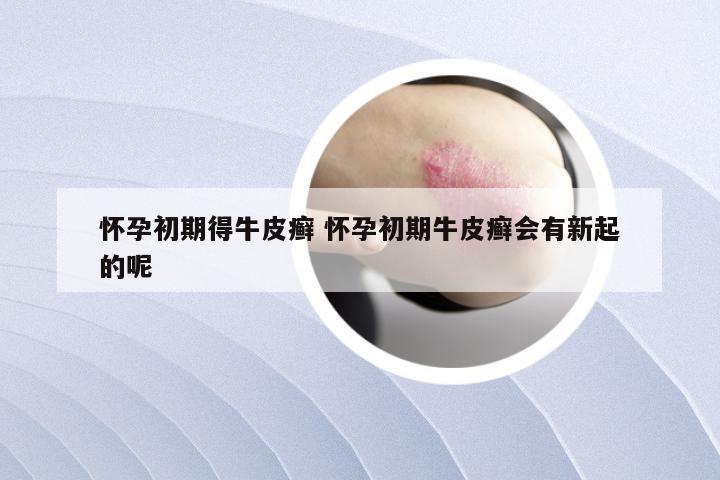 怀孕初期得牛皮癣 怀孕初期牛皮癣会有新起的呢