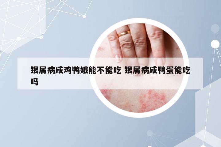 银屑病咸鸡鸭娥能不能吃 银屑病咸鸭蛋能吃吗