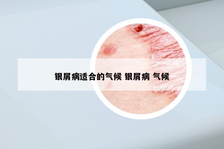 银屑病适合的气候 银屑病 气候
