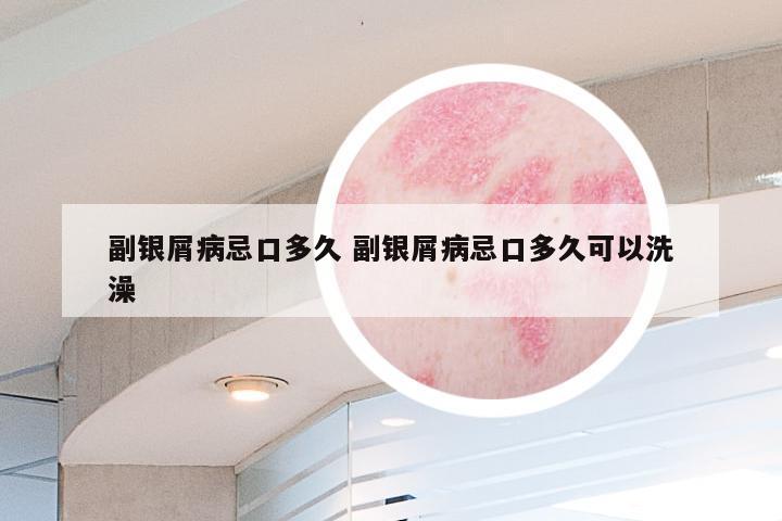 副银屑病忌口多久 副银屑病忌口多久可以洗澡
