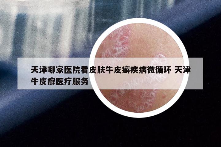 天津哪家医院看皮肤牛皮癣疾病微循环 天津牛皮癣医疗服务