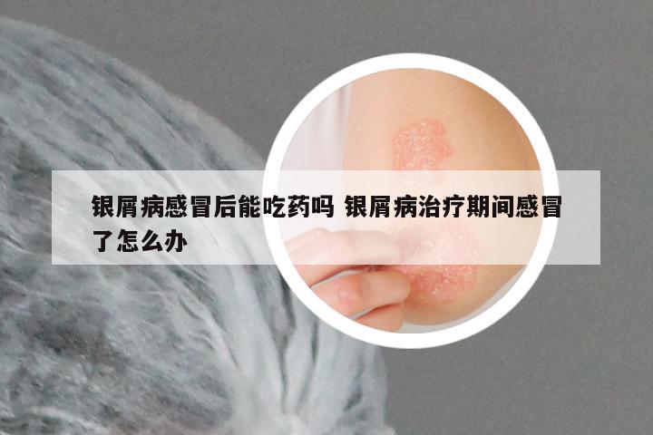 银屑病感冒后能吃药吗 银屑病治疗期间感冒了怎么办