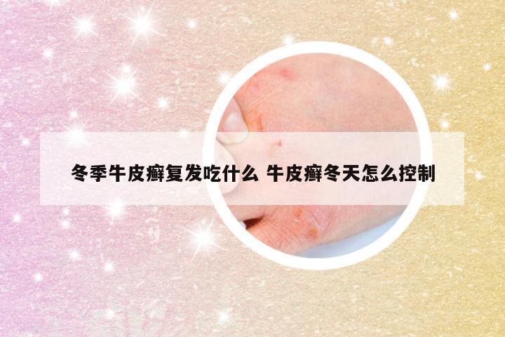 冬季牛皮癣复发吃什么 牛皮癣冬天怎么控制