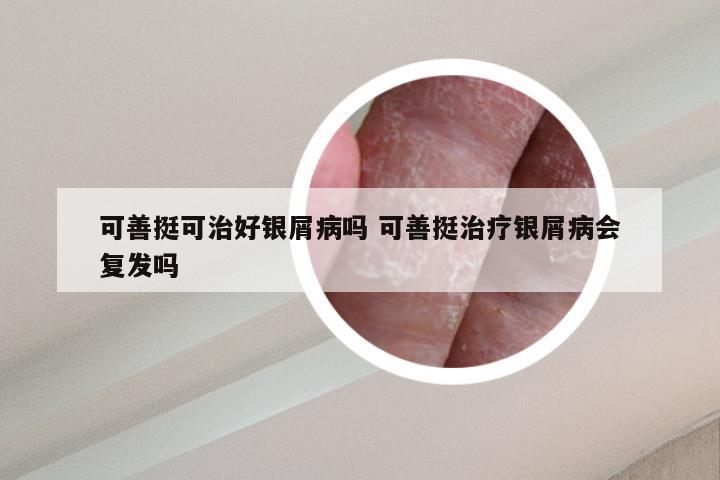 可善挺可治好银屑病吗 可善挺治疗银屑病会复发吗