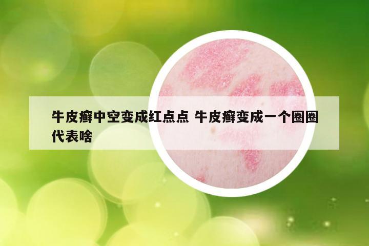 牛皮癣中空变成红点点 牛皮癣变成一个圈圈代表啥