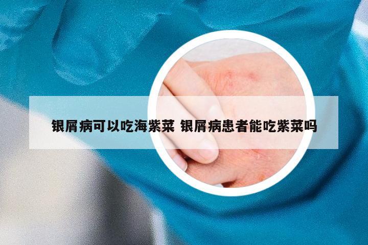 银屑病可以吃海紫菜 银屑病患者能吃紫菜吗