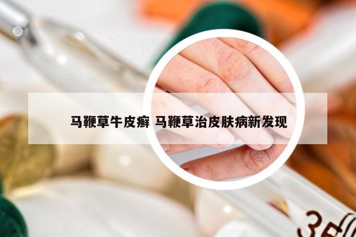 马鞭草牛皮癣 马鞭草治皮肤病新发现