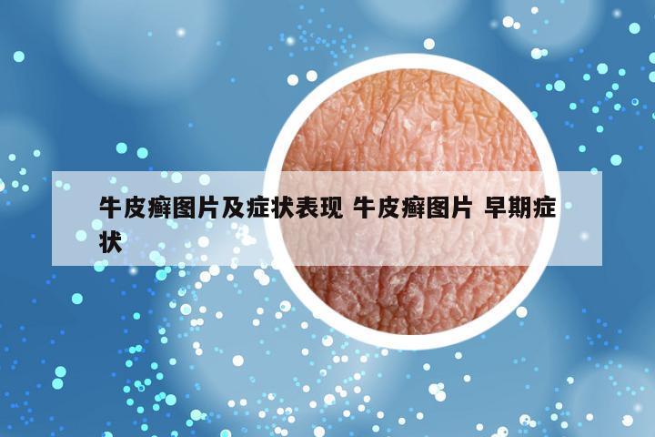 牛皮癣图片及症状表现 牛皮癣图片 早期症状
