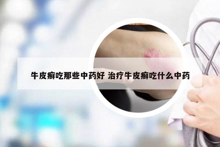 牛皮癣吃那些中药好 治疗牛皮癣吃什么中药