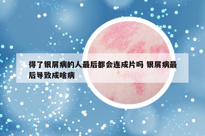 得了银屑病的人最后都会连成片吗 银屑病最后导致成啥病