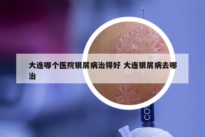 大连哪个医院银屑病治得好 大连银屑病去哪治