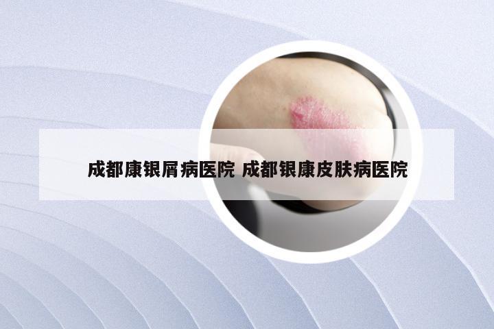 成都康银屑病医院 成都银康皮肤病医院