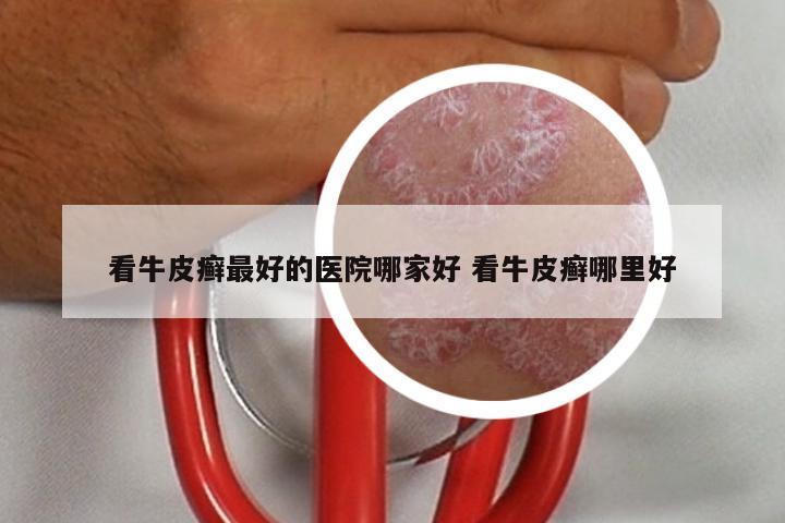 看牛皮癣最好的医院哪家好 看牛皮癣哪里好