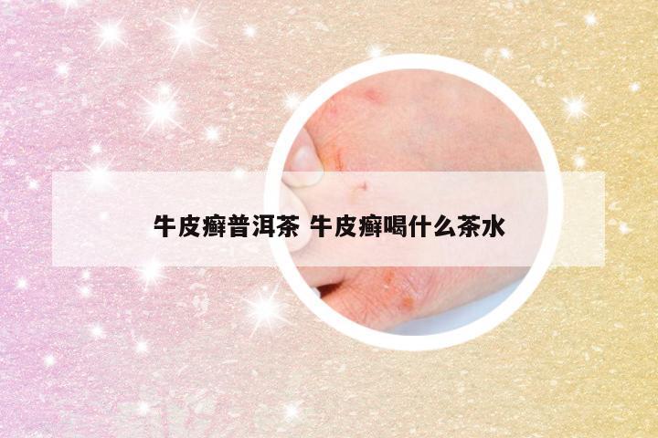 牛皮癣普洱茶 牛皮癣喝什么茶水