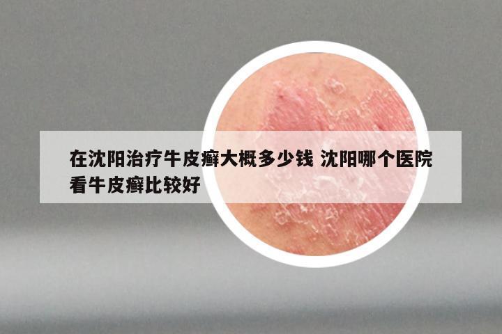 在沈阳治疗牛皮癣大概多少钱 沈阳哪个医院看牛皮癣比较好