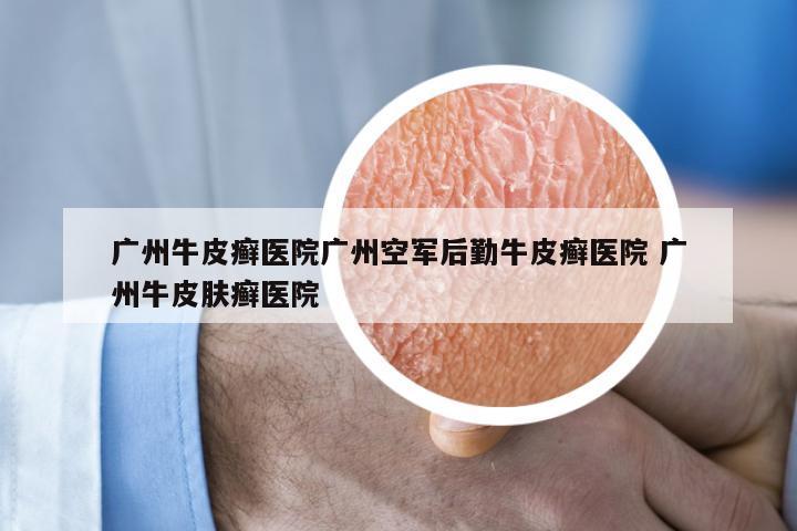 广州牛皮癣医院广州空军后勤牛皮癣医院 广州牛皮肤癣医院