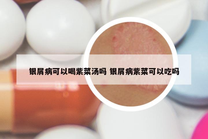 银屑病可以喝紫菜汤吗 银屑病紫菜可以吃吗