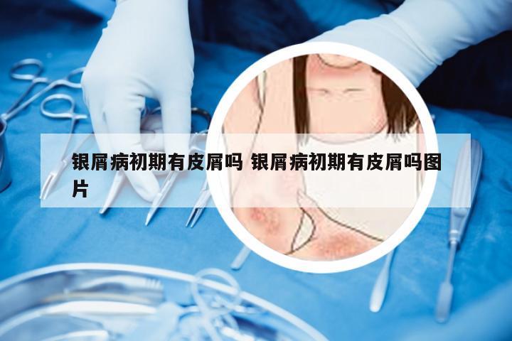 银屑病初期有皮屑吗 银屑病初期有皮屑吗图片