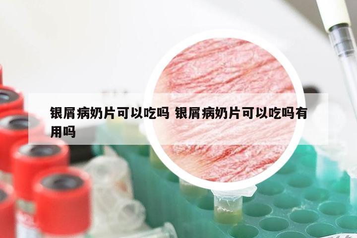 银屑病奶片可以吃吗 银屑病奶片可以吃吗有用吗