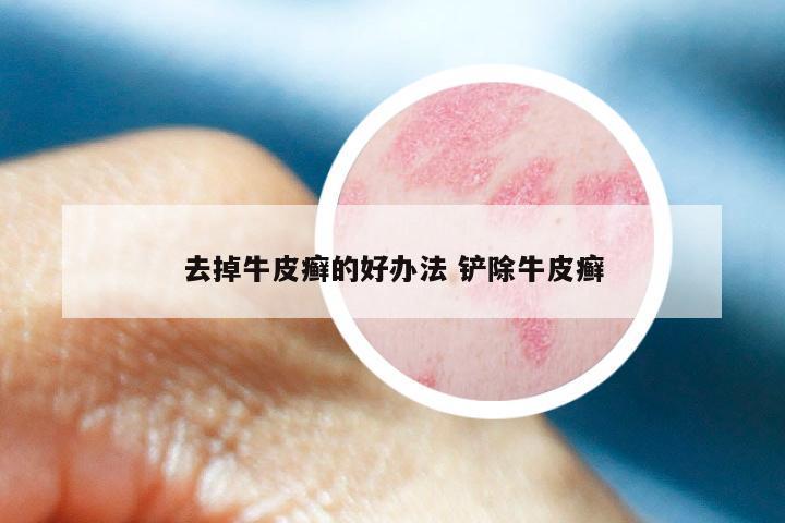 去掉牛皮癣的好办法 铲除牛皮癣