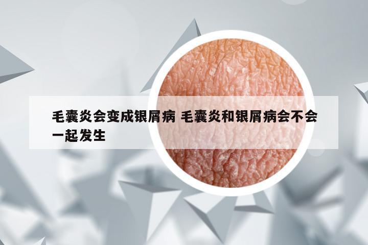 毛囊炎会变成银屑病 毛囊炎和银屑病会不会一起发生