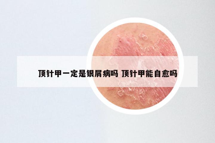 顶针甲一定是银屑病吗 顶针甲能自愈吗