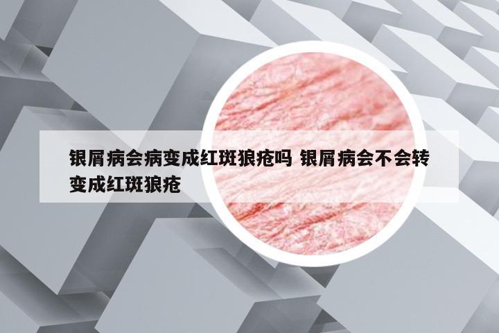 银屑病会病变成红斑狼疮吗 银屑病会不会转变成红斑狼疮