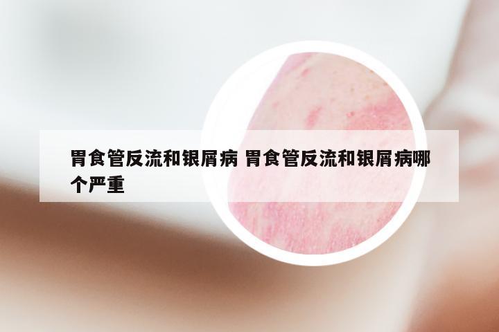 胃食管反流和银屑病 胃食管反流和银屑病哪个严重