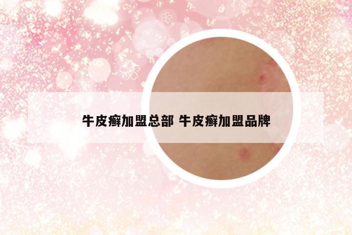 牛皮癣加盟总部 牛皮癣加盟品牌