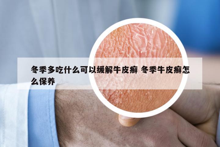 冬季多吃什么可以缓解牛皮癣 冬季牛皮癣怎么保养