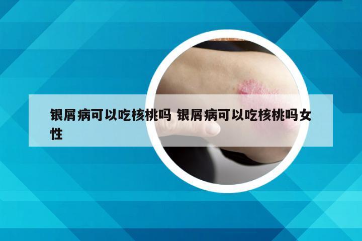 银屑病可以吃核桃吗 银屑病可以吃核桃吗女性