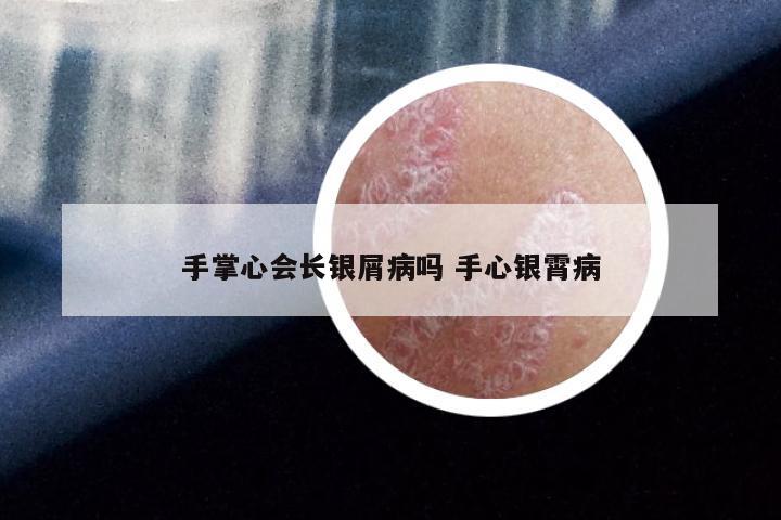 手掌心会长银屑病吗 手心银霄病