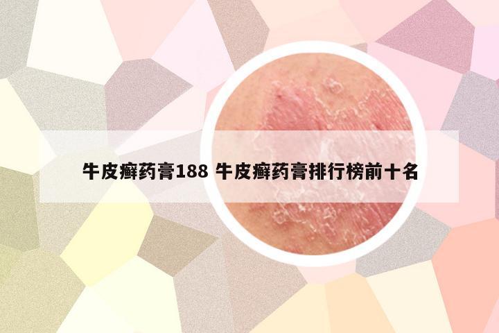 牛皮癣药膏188 牛皮癣药膏排行榜前十名