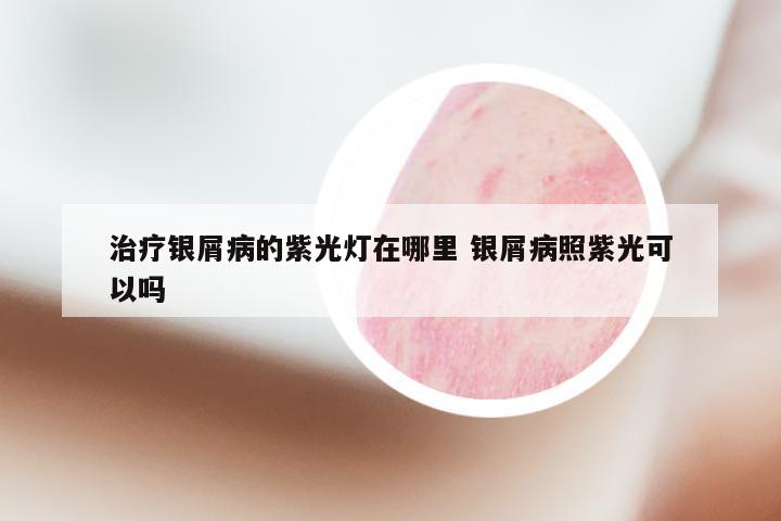 治疗银屑病的紫光灯在哪里 银屑病照紫光可以吗